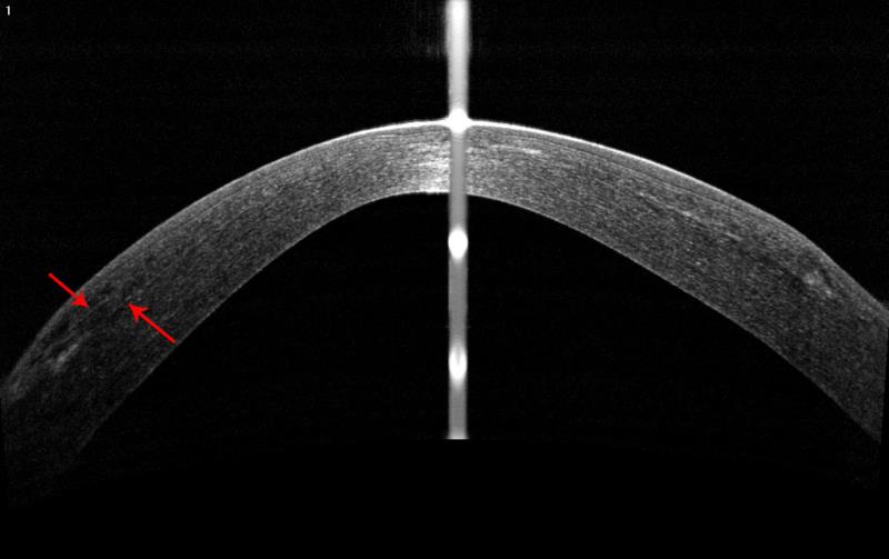 术后2年术眼光学相干断层扫描图像。红色箭头表示植入的透镜边缘。透镜与周边角膜贴合好，边界模糊。贴合好是透镜植入后患者具有良好视觉质量的前提。边界模糊提示透镜与角膜合二为一。