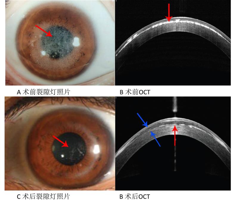 A：手术前角膜中央区可见大量白色浑浊（红色箭头）。B：光学相干断层扫描中白色高亮处即为混浊灶（红色箭头）。C：术后6月角膜中央区明显变透明（红色箭头）。D：透镜与角膜贴合好（蓝色箭头示放置的透镜），角膜混浊明显减轻（红色箭头）。