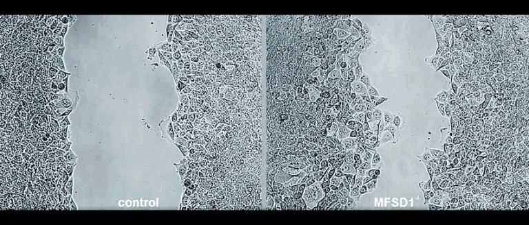 奥地利科技学院研究发现：MFSD1的蛋白质会抑制癌细胞的转移