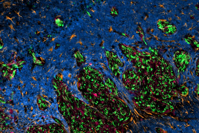 胶质母细胞瘤侵袭的关键作用揭示，有助研发下一代脑癌疗法