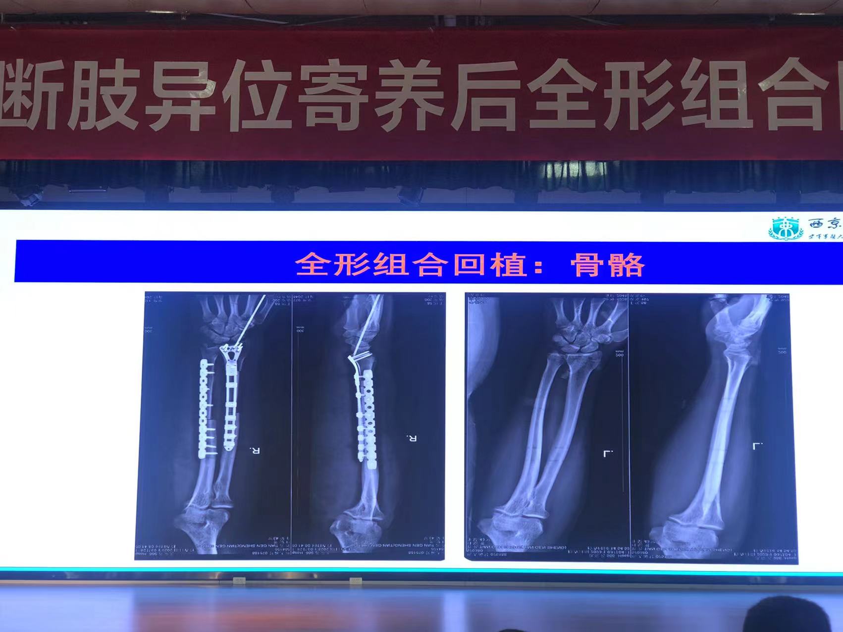 陕西西安：一只被机器意外绞断的手臂寄养其小腿后再回植成功-中国科技网