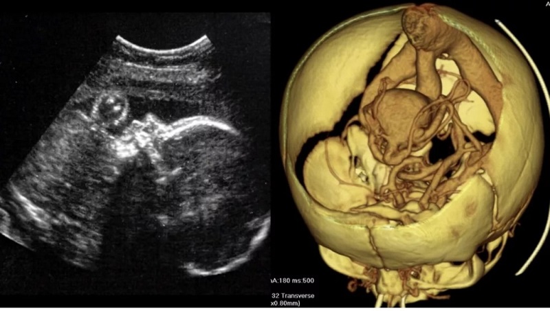 首次出生前胎儿脑部手术成功实施