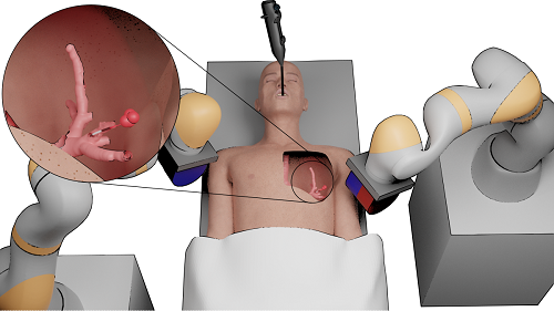 微型手术机器人或改变肺癌诊疗方式