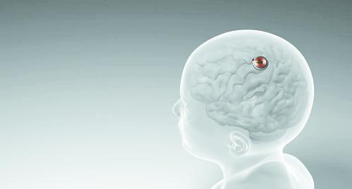 首例脑机接口设备人体移植完成