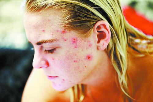 工程皮肤细菌能有效治疗“痘痘”