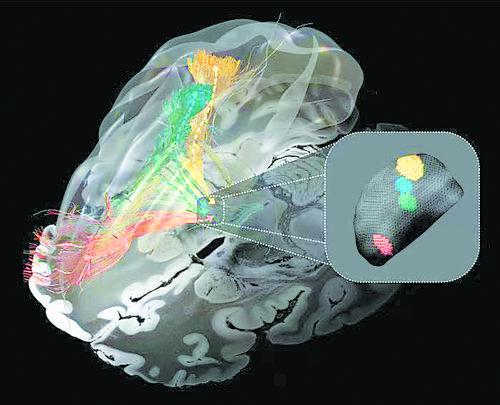 鉴别致病的脑环路——深脑刺激图谱有助改进神经疾病疗法
